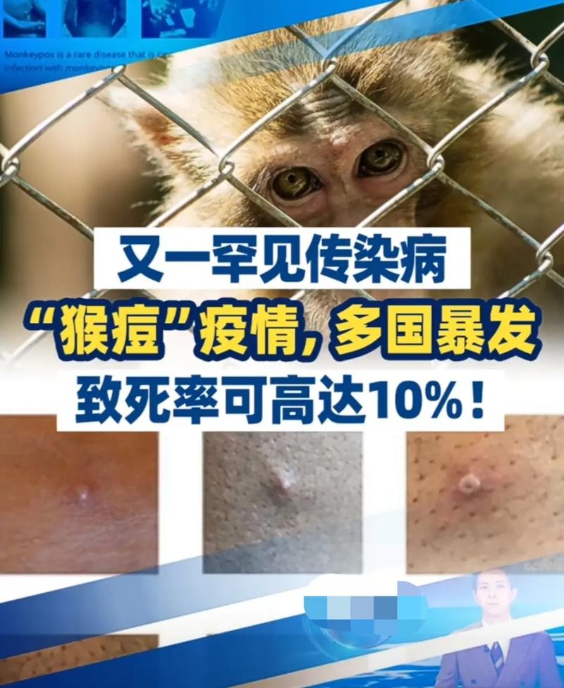 猴痘已经波及12国，致死率高达10%，40岁以下人群无免疫力，美国已采购数百万剂疫苗，我们应该担心吗猴痘病毒的传播途径欧美多国突发“猴痘”疫情，到底多严重